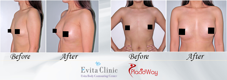 Know everything about breast augmentation surgery in Philippines at Medical City Clark